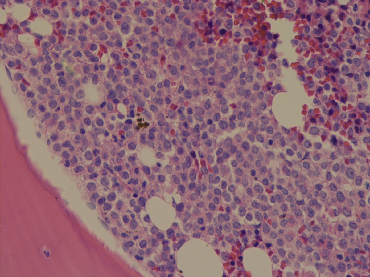 Bone marrow 12062009